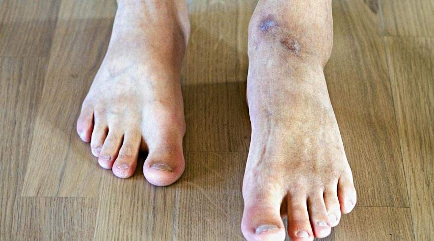 Ved ulykken sidste år kom Ole Byskovs fod i klemme i en ventil, der manglede afskærmning. Han får aldrig sin fulde førlighed tilbage.